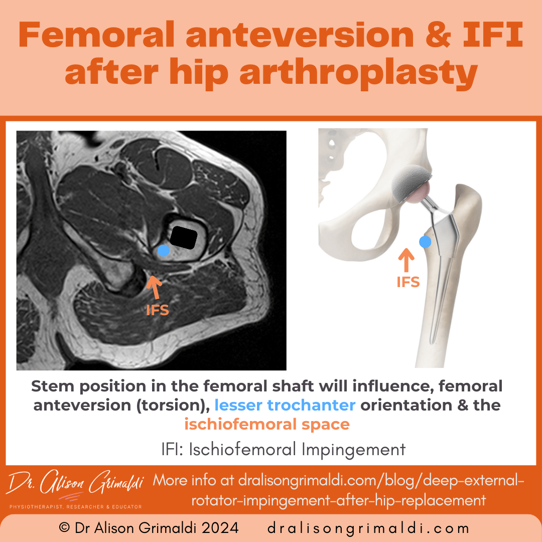 femoral-anteversion-&-IFI-after-hip-arthroplasty