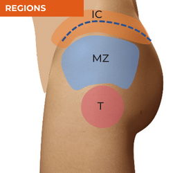 Differential Diagnosis of Hip Pain_Regions of the Lateral Hip