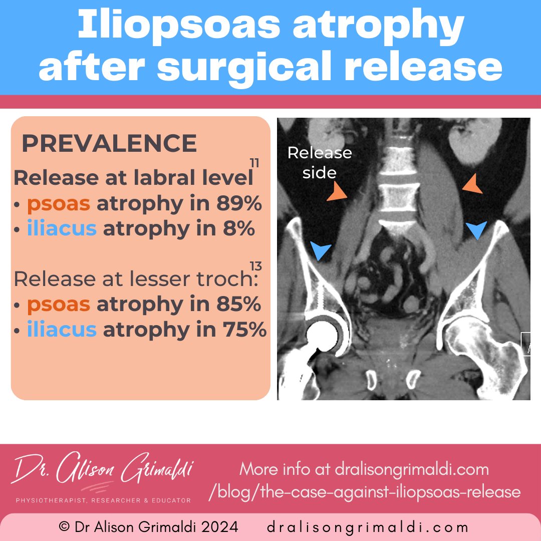 prevalence-of-iliopsoas-atrophy-after-surgical-release