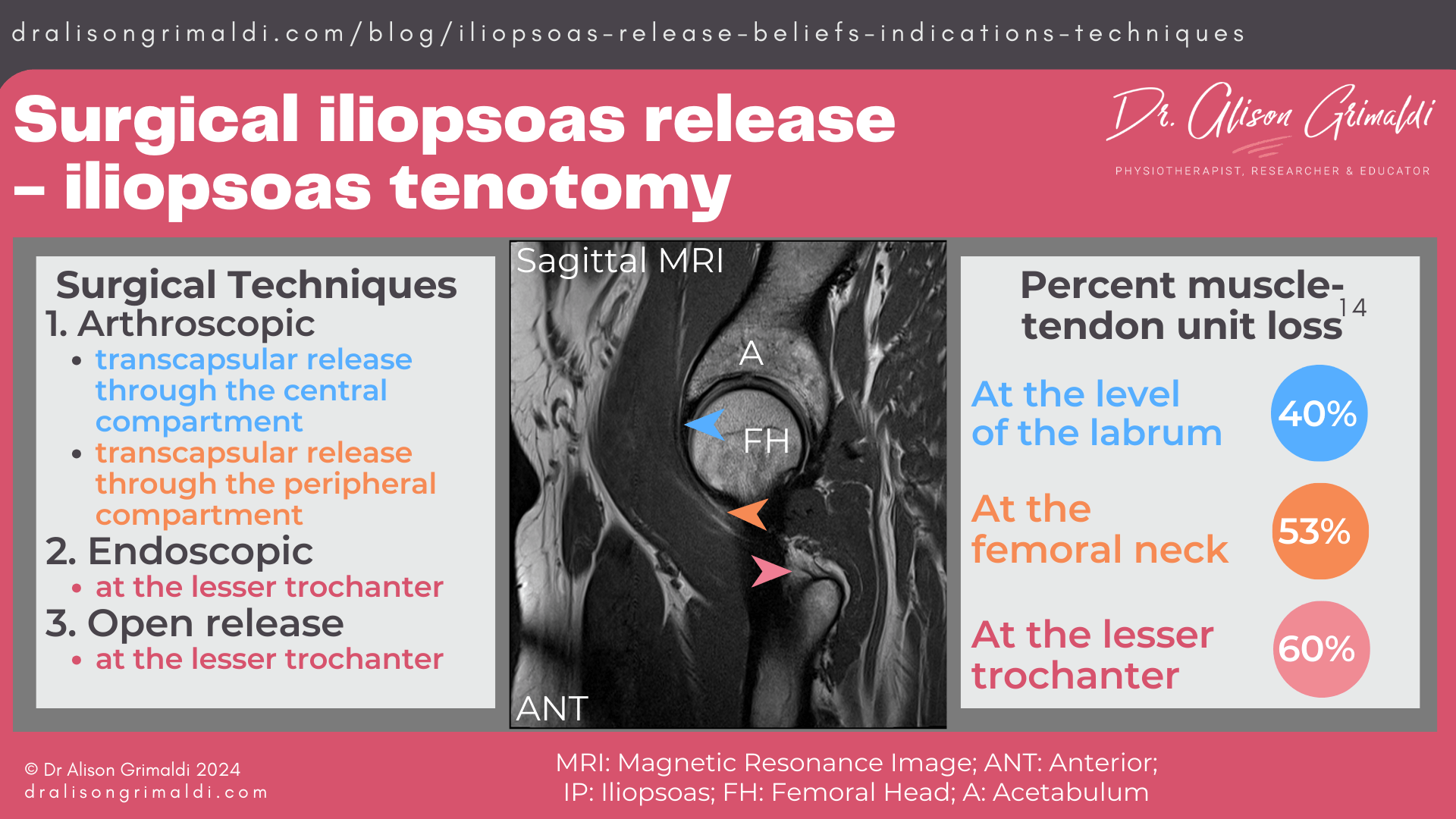 Surgical-iliopsoas-release-iliopsoas-tenotomy