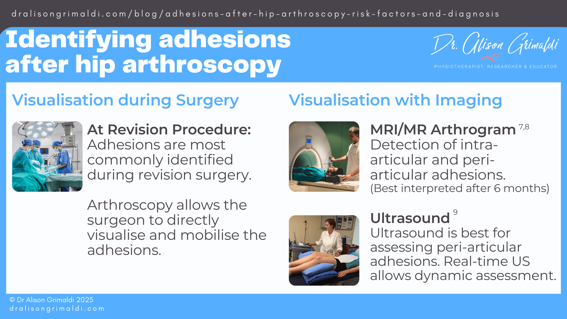 Identifying-adhesions-after-hip-arthroscopy