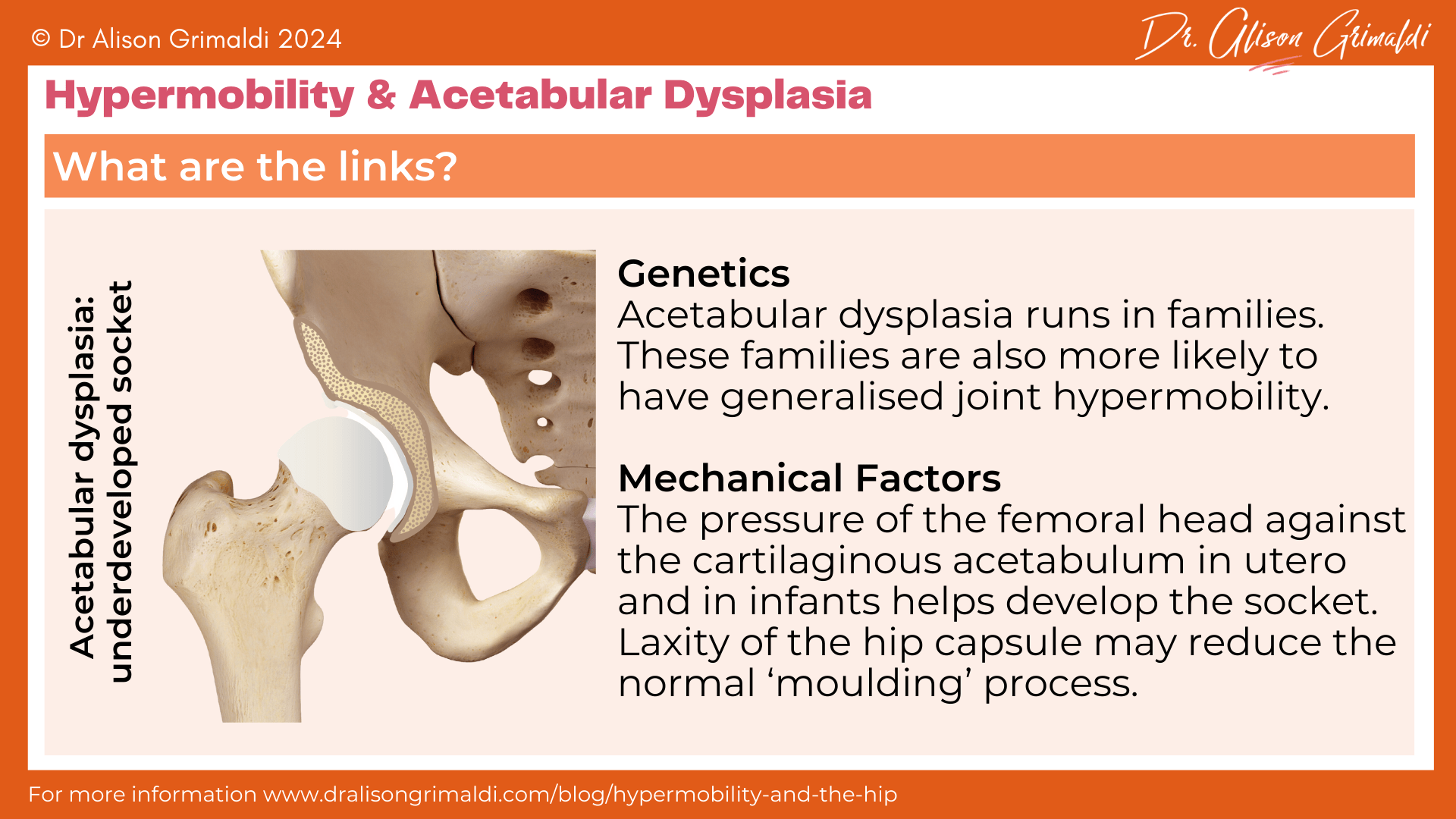 hypermobility-and-acetabular-dysplasia