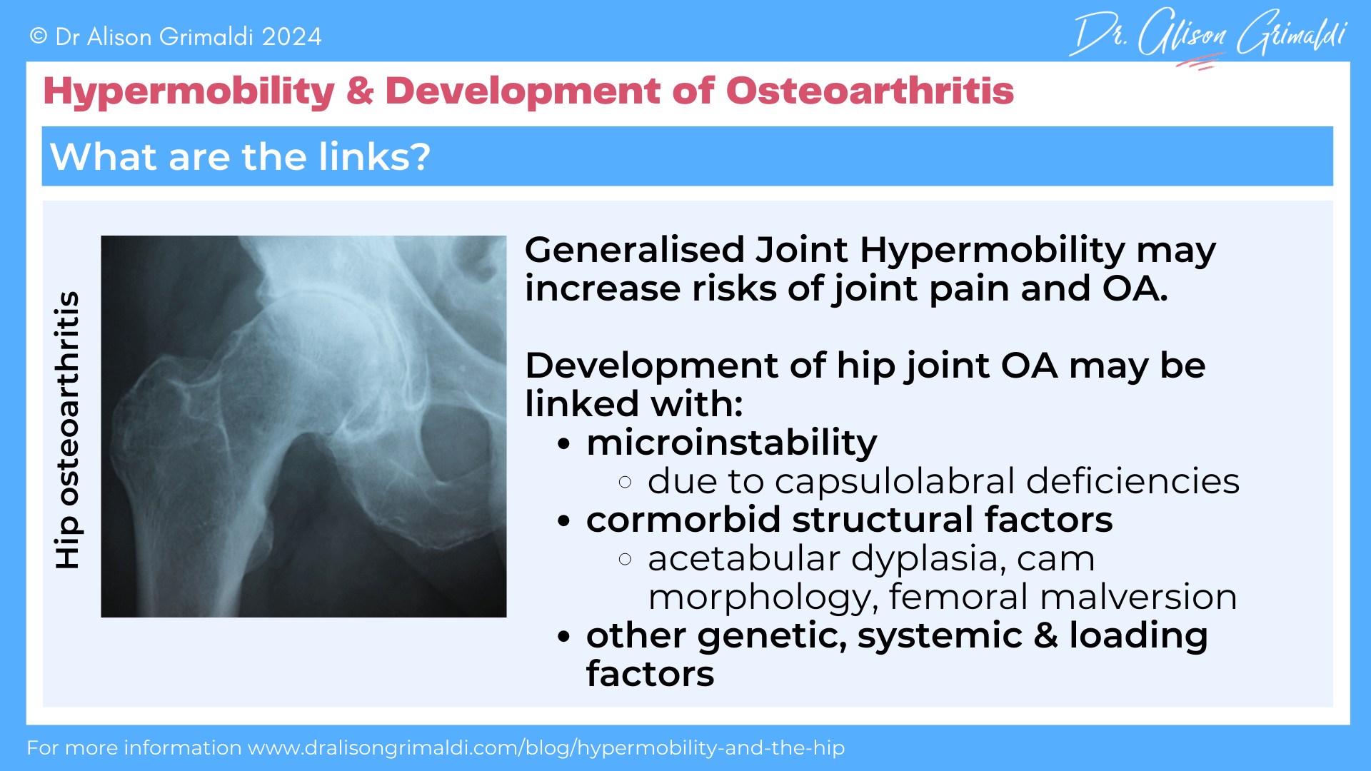 hypermobility-and-development-of-osteoarthritis