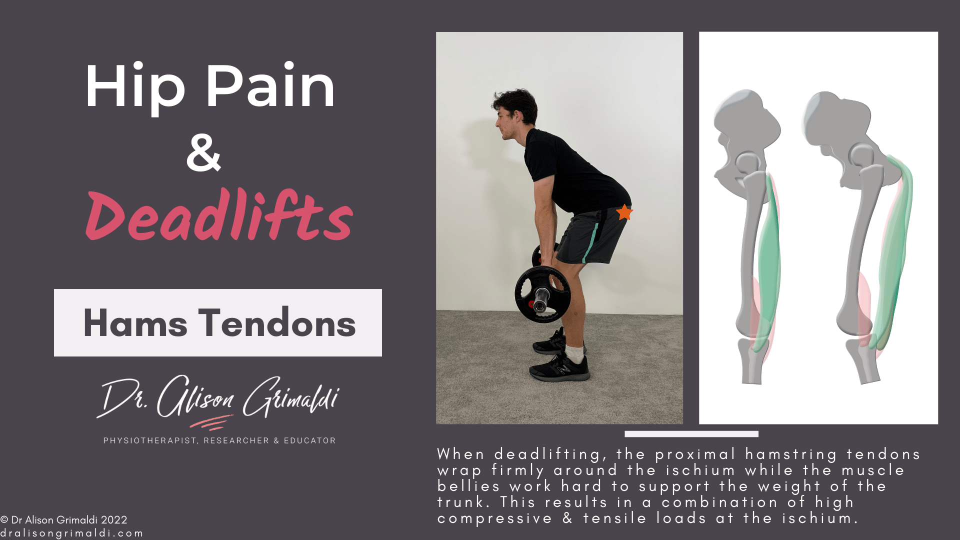 Proximal hamstring tendinopathy and deadlifts_dralisongrimaldi_blog