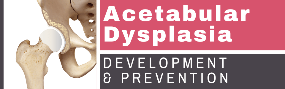 Acetabular Dysplasia: Development, Impact, Prevention Acetabular Dysplasia: Development, Impact, Prevention