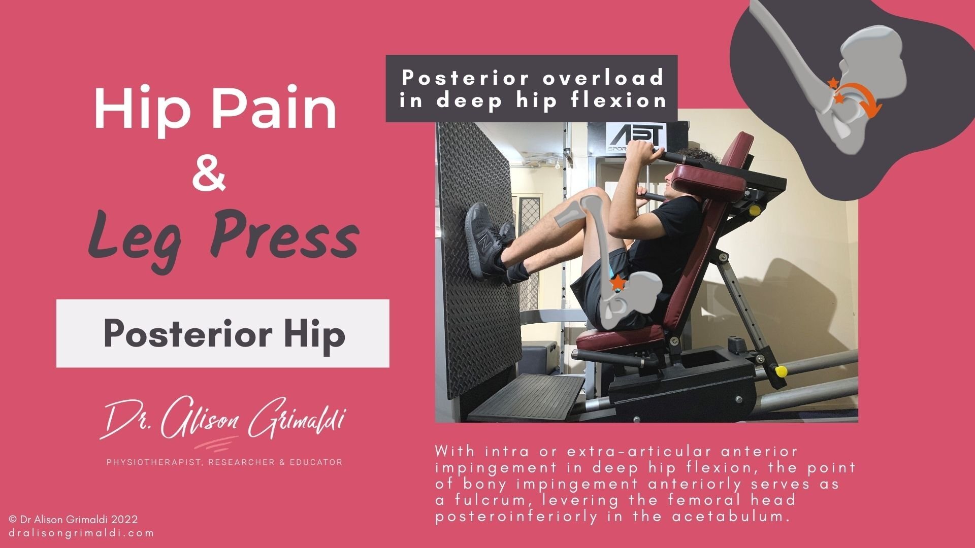 Posterior hip pain and leg press_dralisongrimaldi_blog Posterior hip pain and leg press on dralisongrimaldi blog