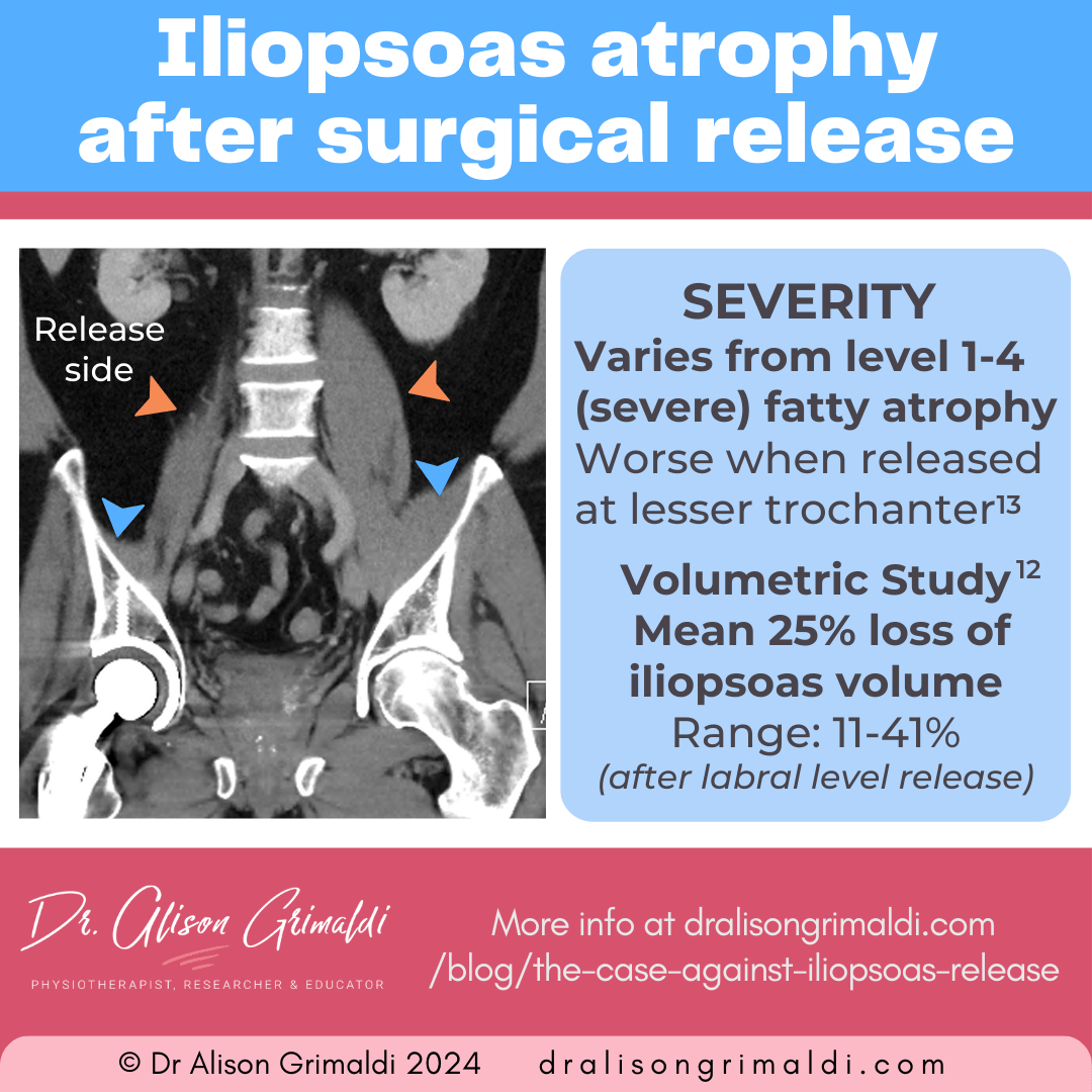 severity-of-iliopsoas-atrophy-after-surgical-release severity-of-iliopsoas-atrophy-after-surgical-release