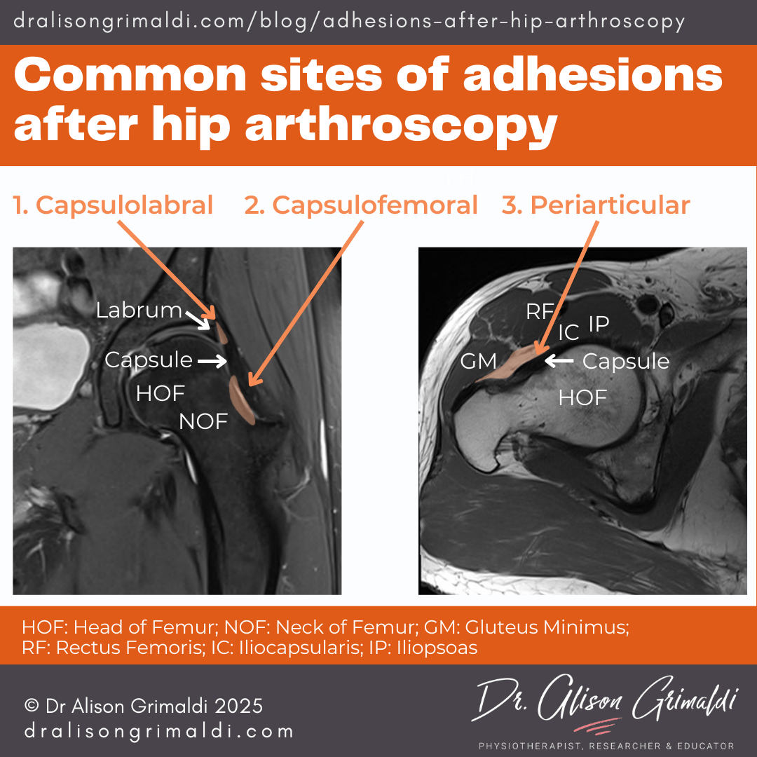 Common-sites-of-adhesions-after-hip-arthroscopy Common-sites-of-adhesions-after-hip-arthroscopy
