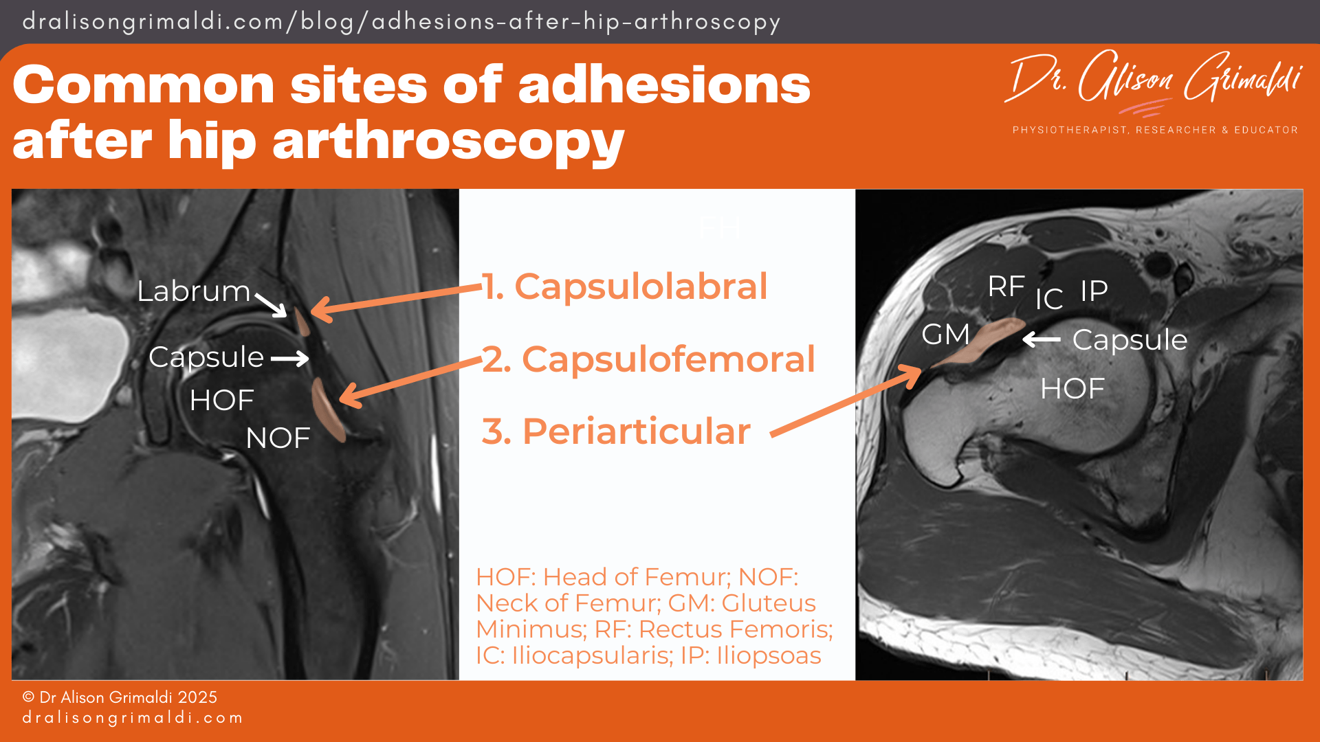 Common-sites-of-adhesions-after-hip-arthroscopy Common-sites-of-adhesions-after-hip-arthroscopy