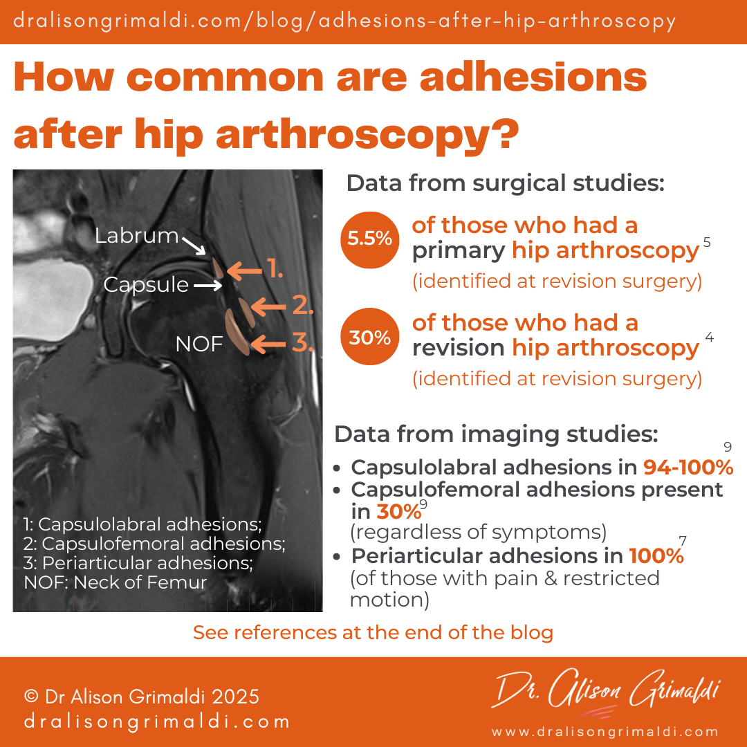 How-common-are-adhesions-after-hip-arthroscopy How-common-are-adhesions-after-hip-arthroscopy