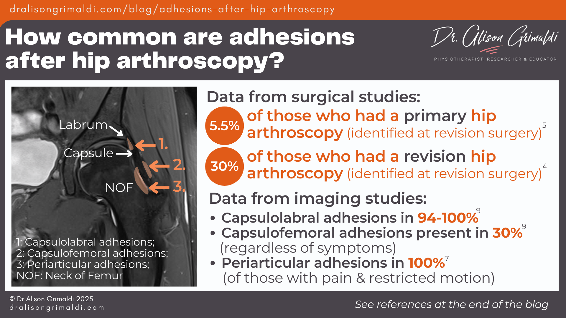 How-common-are-adhesions-after-hip-arthroscopy How-common-are-adhesions-after-hip-arthroscopy