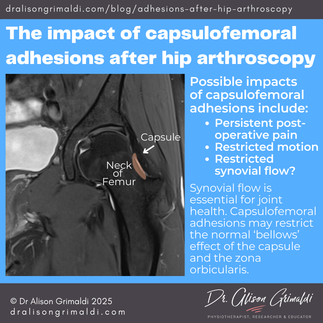 The-impact-of-capsulofemoral-adhesions-after-hip-arthroscopy The-impact-of-capsulofemoral-adhesions-after-hip-arthroscopy