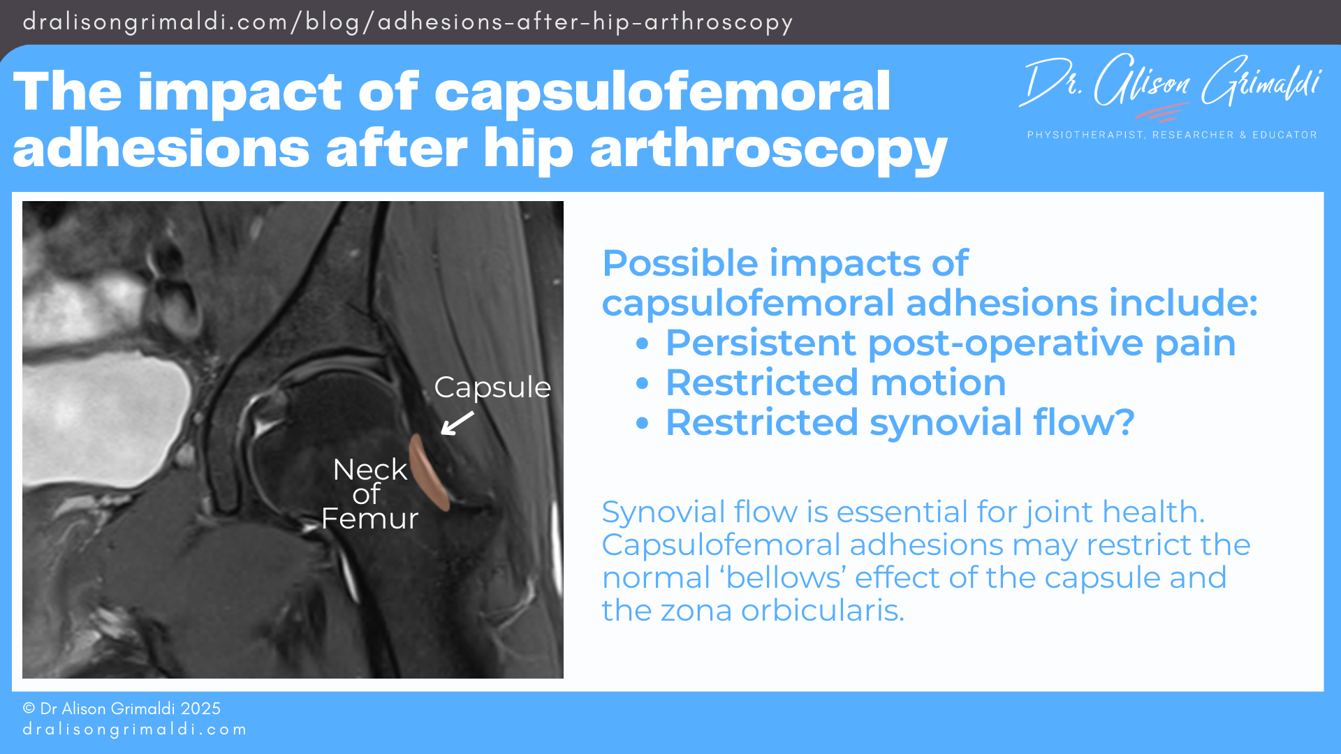 The-impact-of-capsulofemoral-adhesions-after-hip-arthroscopy The-impact-of-capsulofemoral-adhesions-after-hip-arthroscopy
