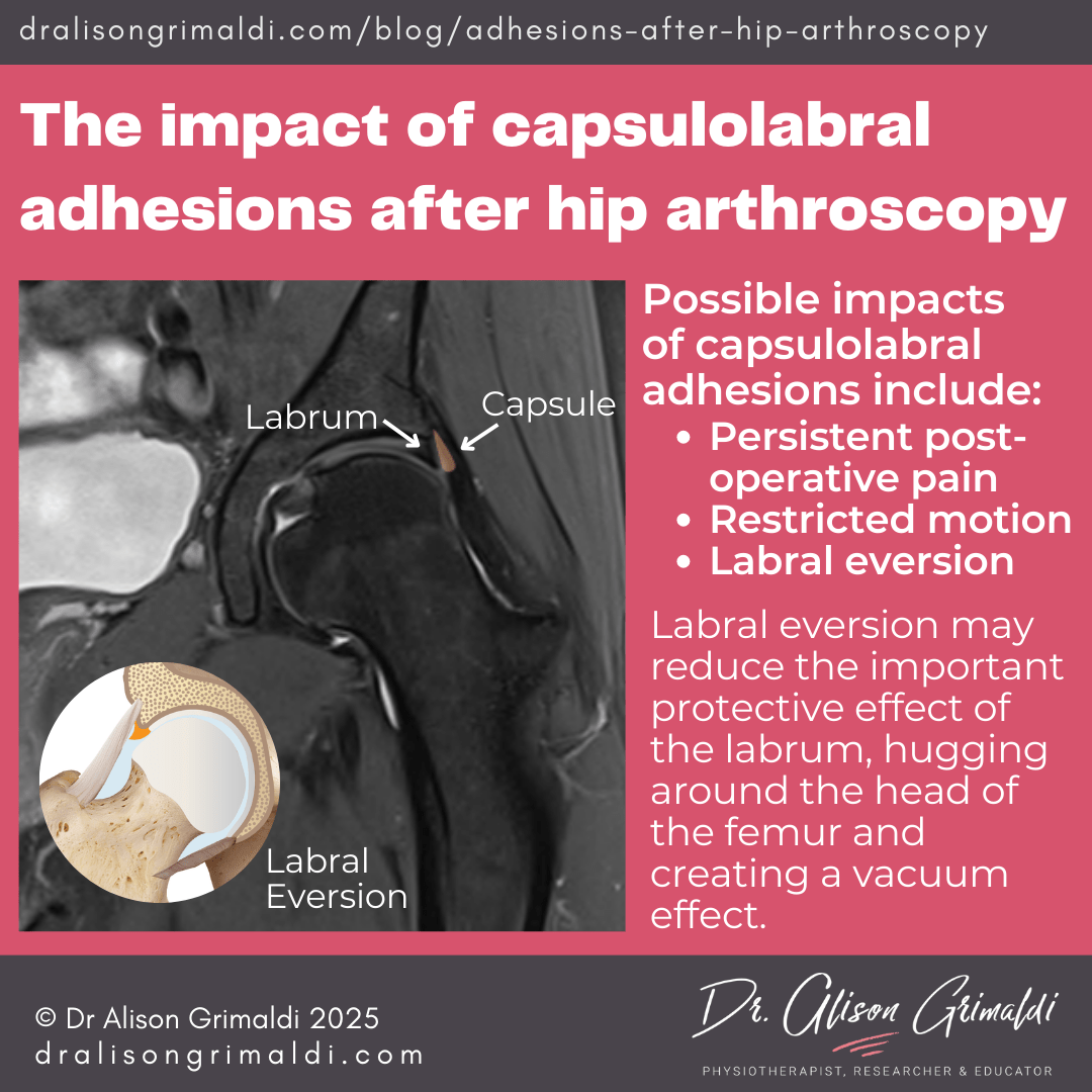The-impact-of-capsulolabral-adhesions-after-hip-arthroscopy The-impact-of-capsulolabral-adhesions-after-hip-arthroscopy