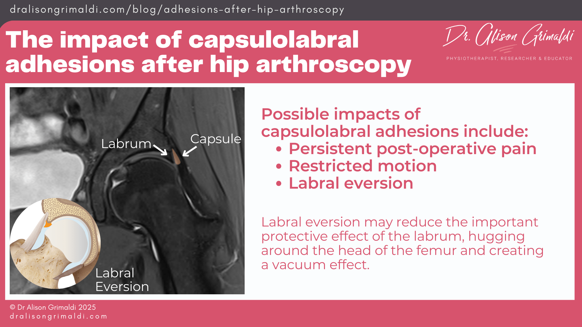 The-impact-of-capsulolabral-adhesions-after-hip-arthroscopy The-impact-of-capsulolabral-adhesions-after-hip-arthroscopy