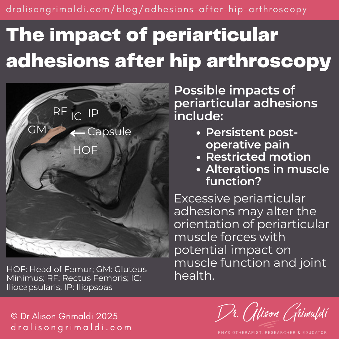 The-impact-of-periarticular-adhesions-after-hip-arthroscopy The-impact-of-periarticular-adhesions-after-hip-arthroscopy
