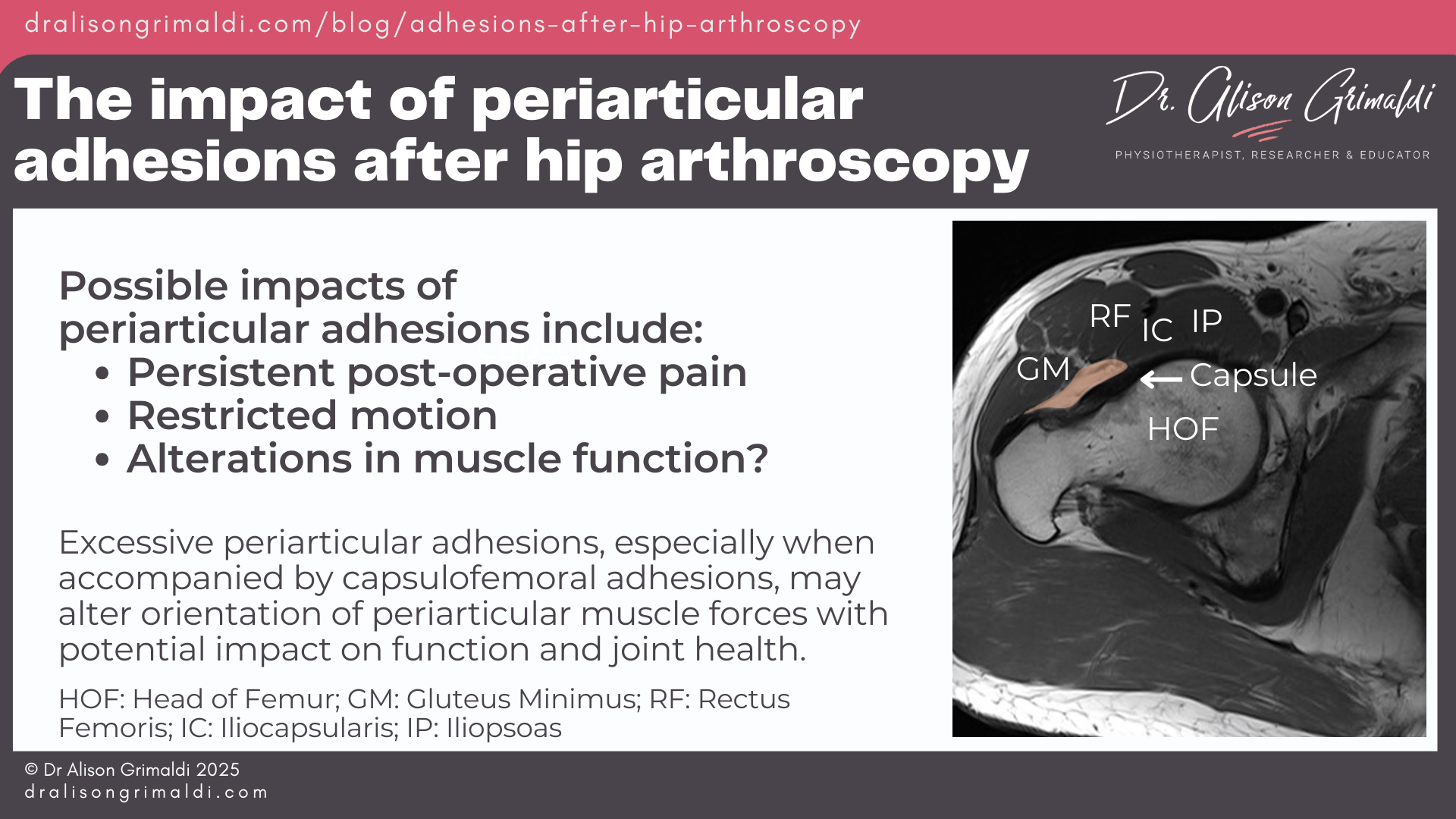 The-impact-of-periarticular-adhesions-after-hip-arthroscopy The-impact-of-periarticular-adhesions-after-hip-arthroscopy