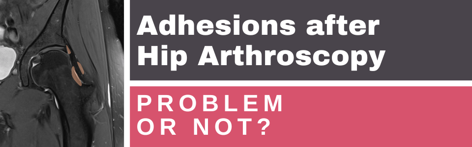 adhesions-after-hip-arthroscopy-prevention-&-treatment adhesions-after-hip-arthroscopy-prevention-&-treatment