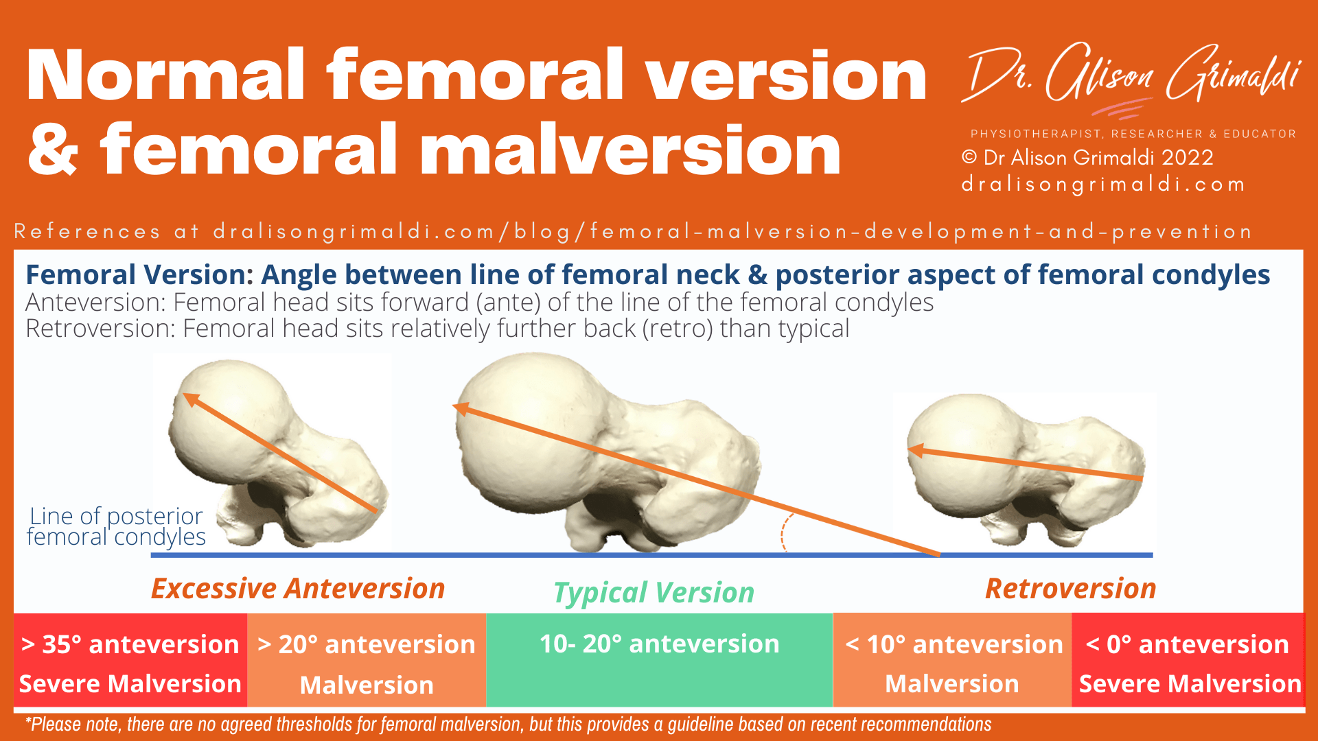 Normal femoral version & femoral malversion Normal femoral version & femoral malversion