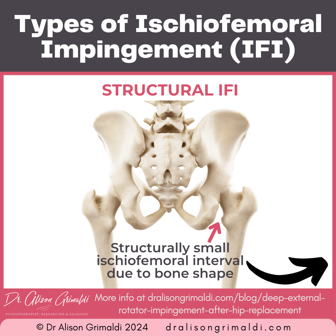 types-of-ischiofemoral-impingement