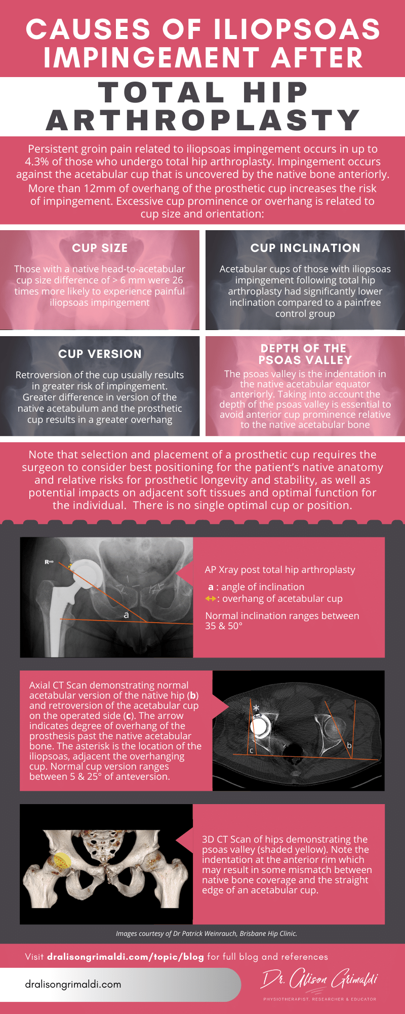 Iliopsoas impingement after THR_Alison Grimaldi Infographic from August 2020 blog