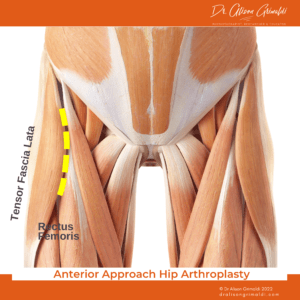 Anterior Approach Hip Arthroplasty_Dr Alison Grimaldi Blog Anterior Approach Hip Arthroplasty