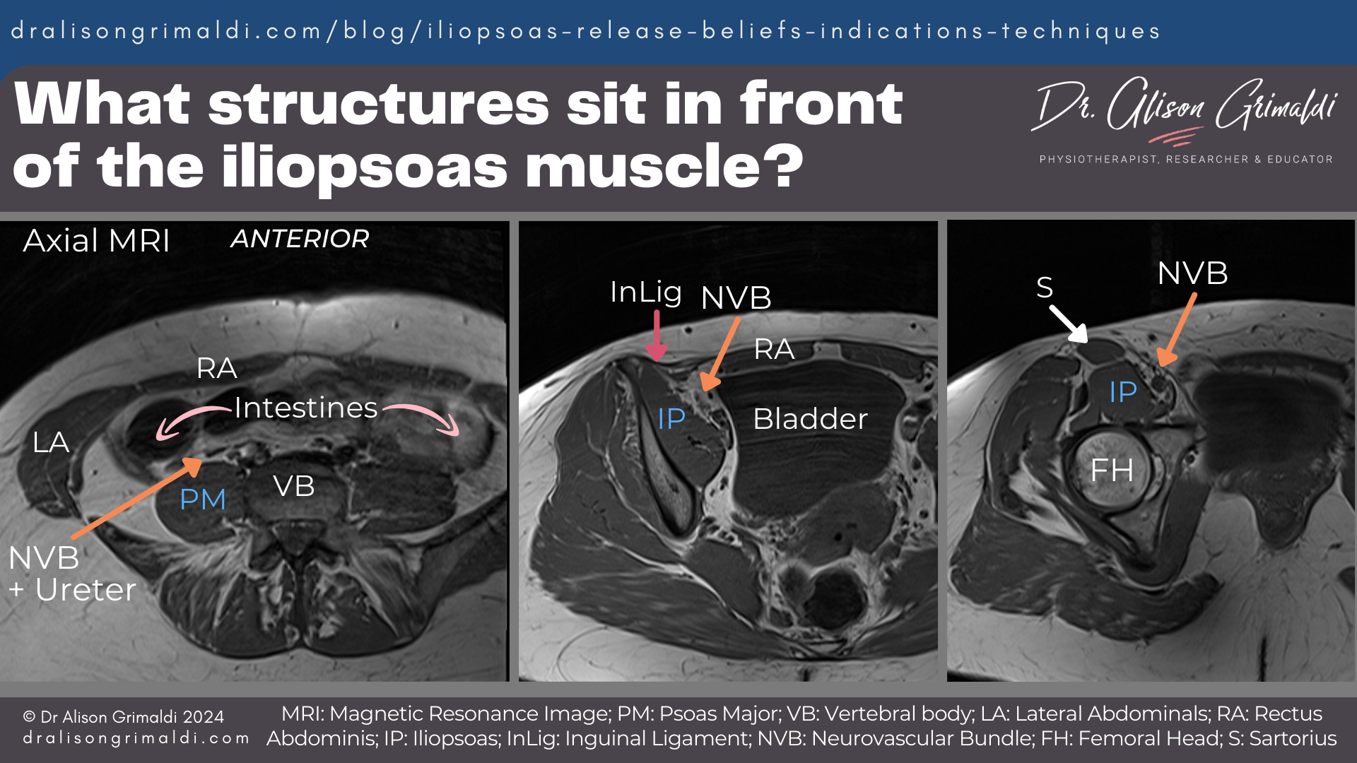 What-structures-sit in-front-of-the-iliopsoas-muscle What-structures-sit in-front-of-the-iliopsoas-muscle