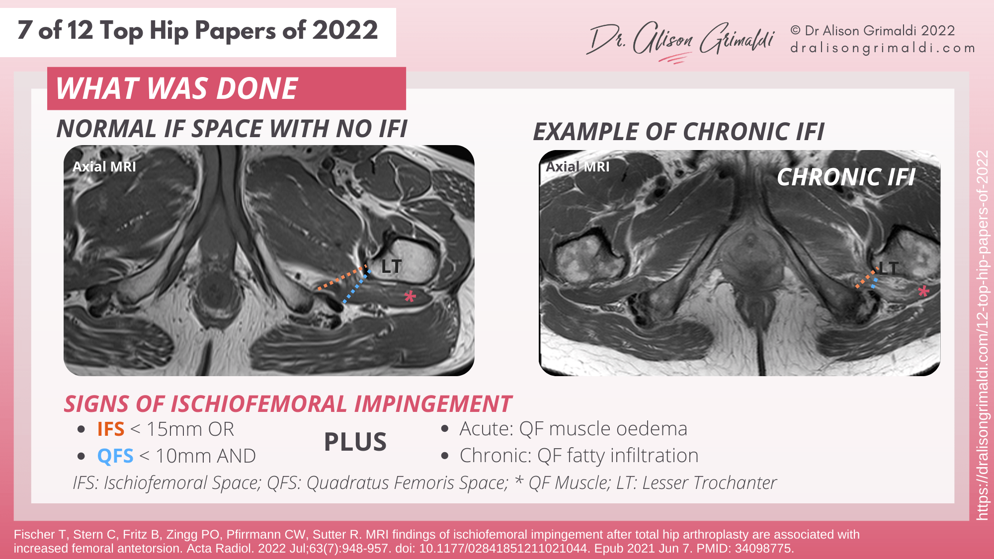 What Was Done - 7 of 12 - IFI, surgery, total hip arthroplasty, total hip replacement What Was Done - 7 of 12 - IFI, surgery, total hip arthroplasty, total hip replacement