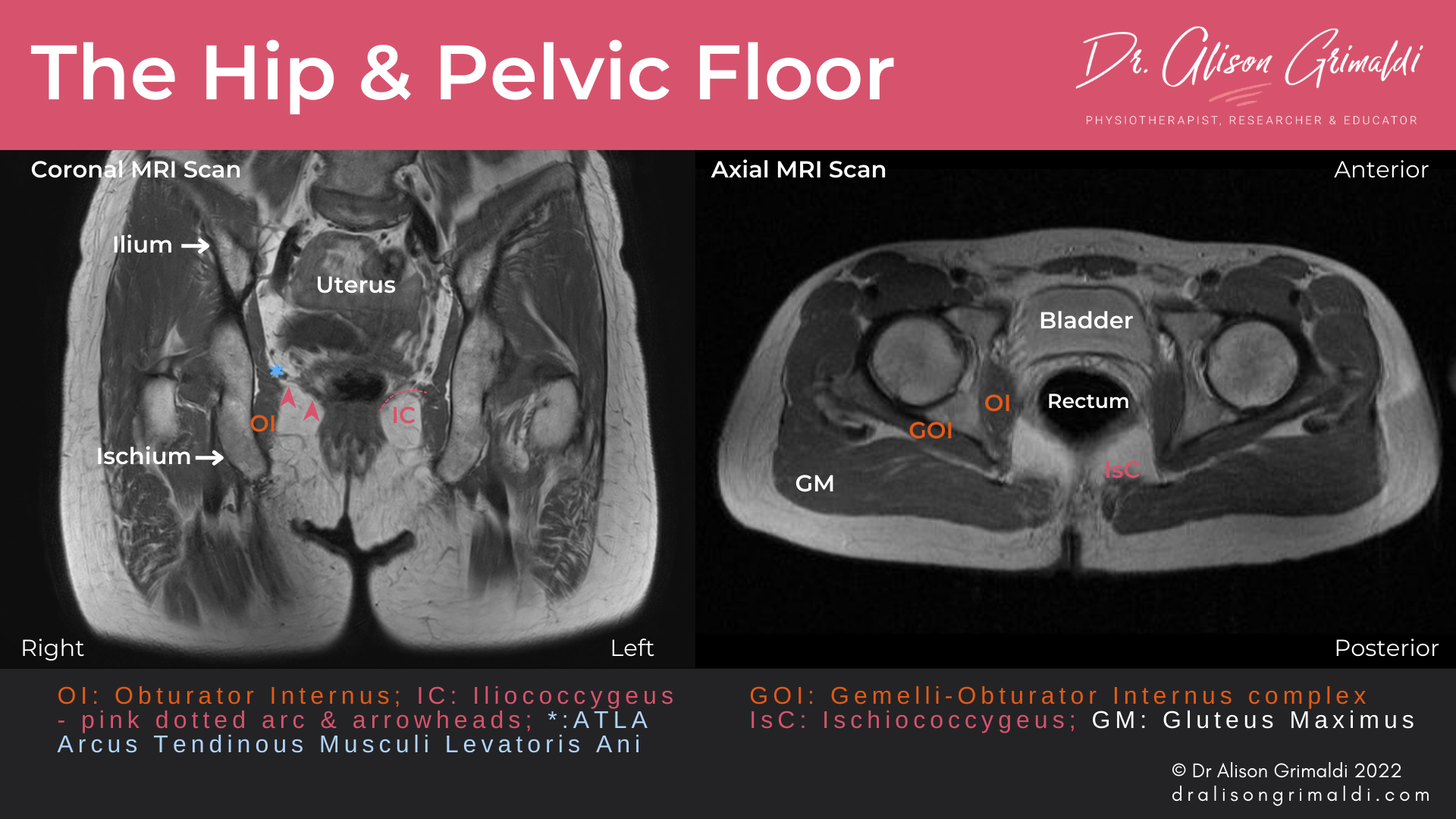 MRI Scans showing the anatomical relationships of the hip and pelvic floor MRI Scans showing the anatomical relationships of the hip and pelvic floor