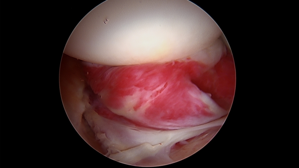 Synovitis of the Ligamentum Teres & Pulvinar Fat Pad