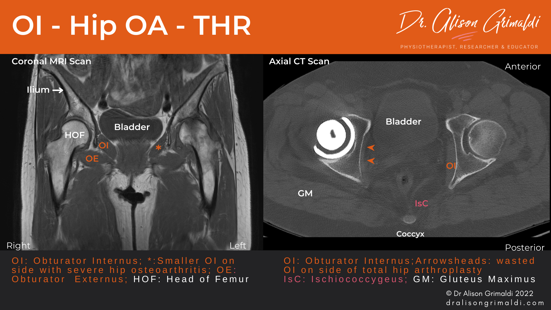 Obturator Internus in Hip OA and after Hip Replacement_Dr Alison Grimaldi_Blog MRI and CT Scan of Obturator Internus in Hip OA and after Hip Replacement