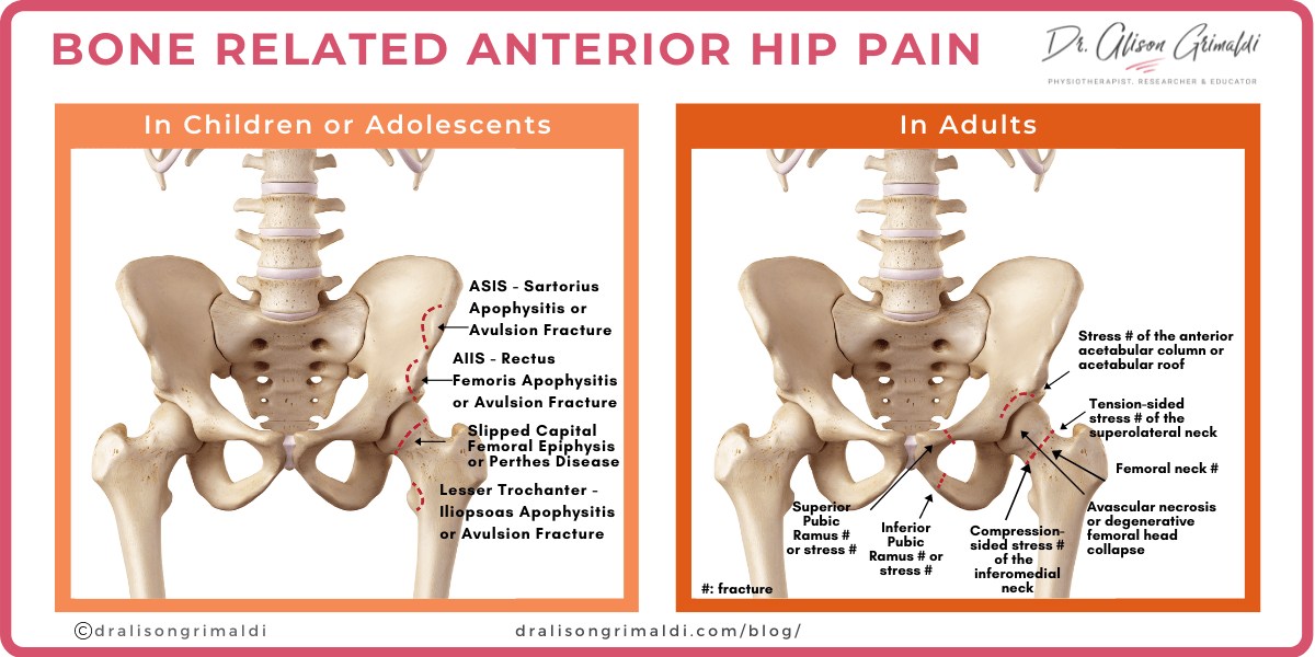 Bone Related Anterior Hip Pain Infographic Bone Related Anterior Hip Pain Infographic