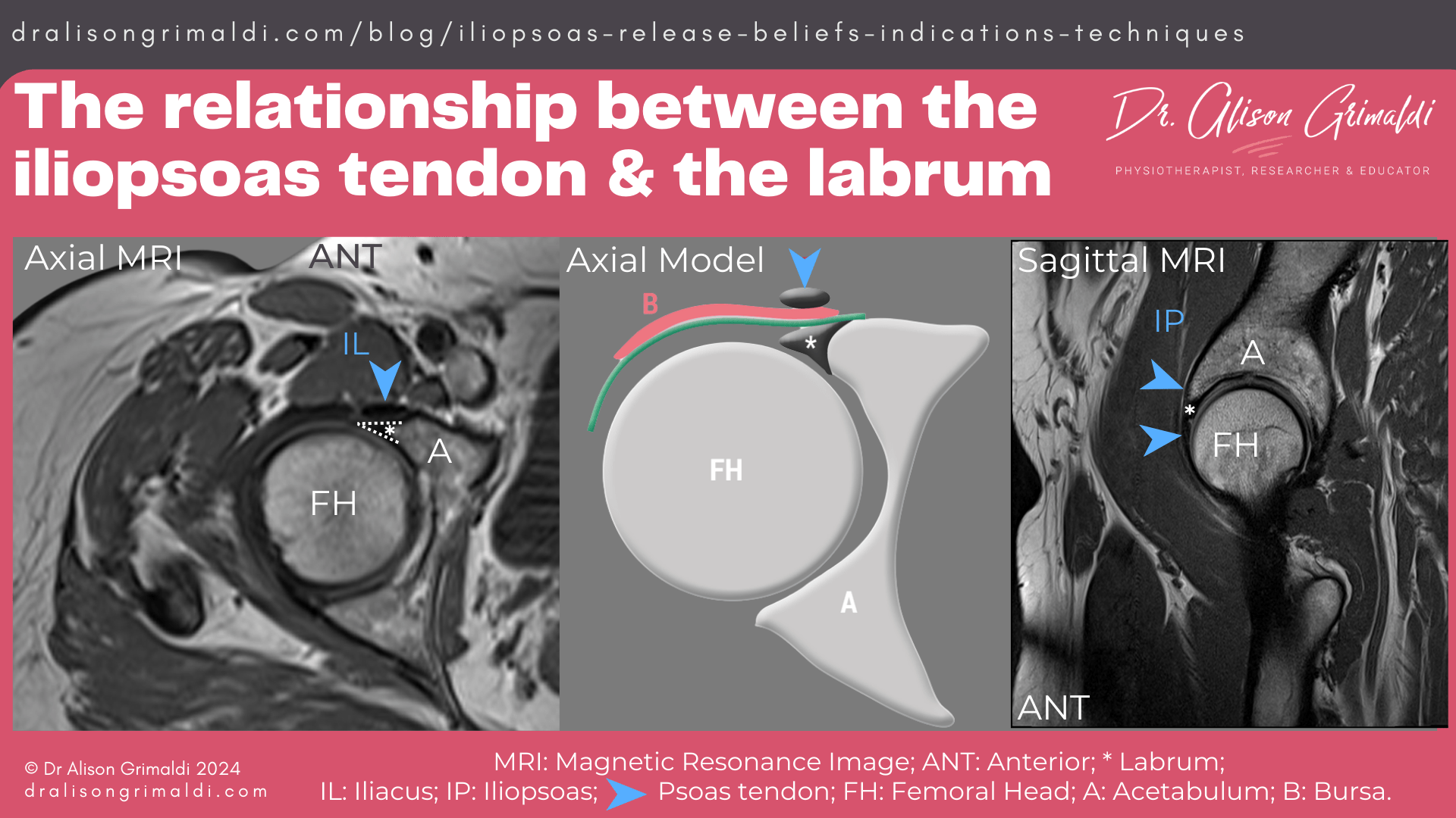 The-relationship-between-the-iliopsoas-tendon-&-the-labrum The-relationship-between-the-iliopsoas-tendon-&-the-labrum