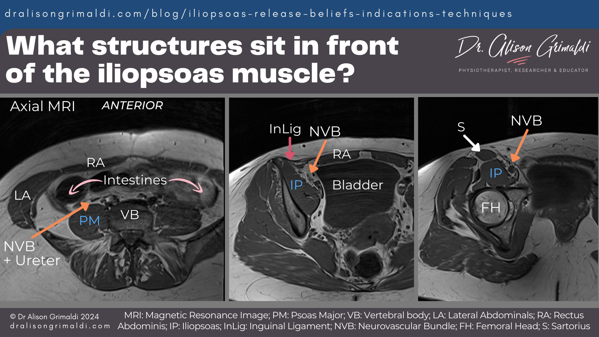 What-structures-sit in-front-of-the-iliopsoas-muscle What-structures-sit in-front-of-the-iliopsoas-muscle