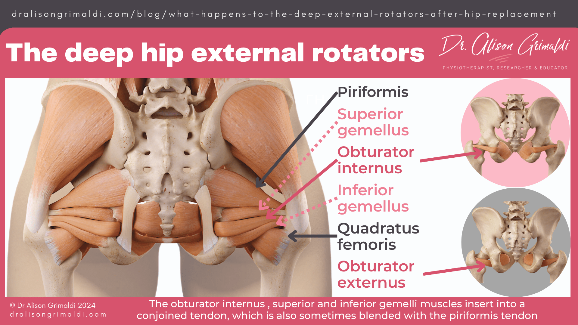 ischiofemoral-impingement ischiofemoral-impingement