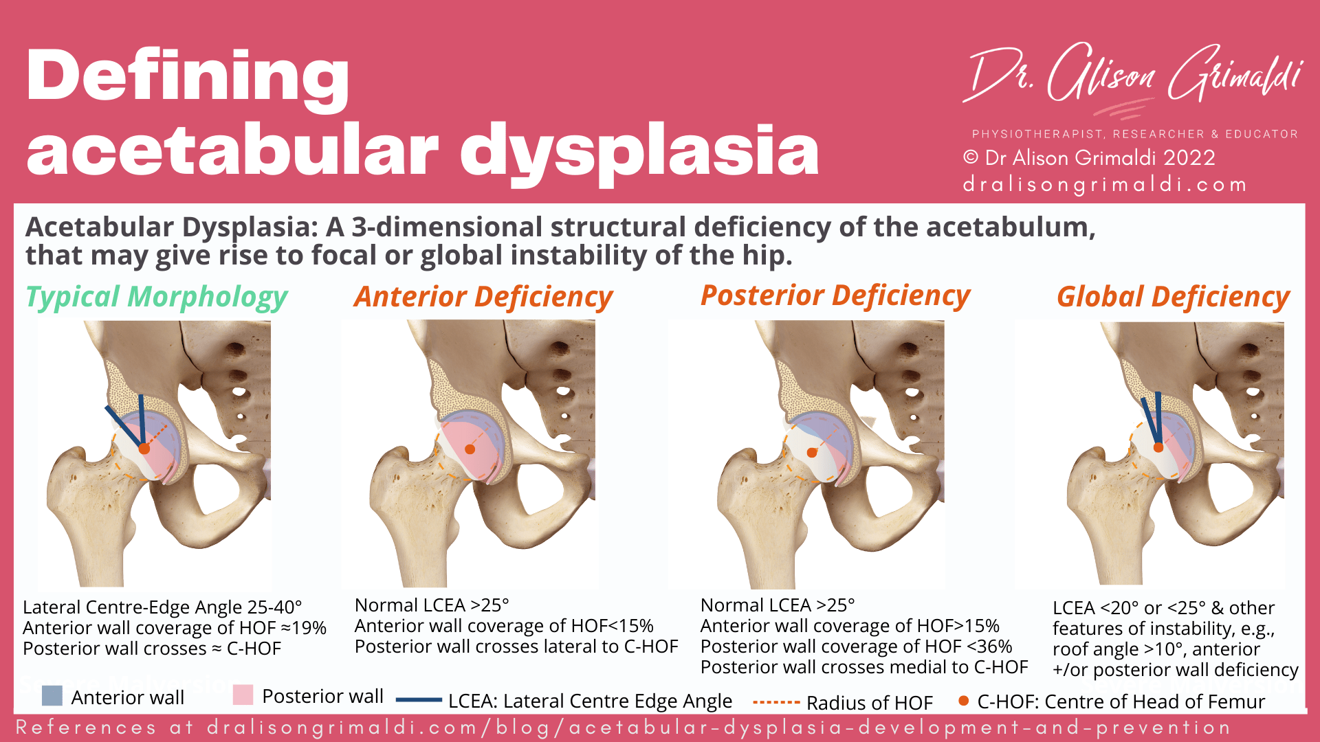 Defining acetabular dysplasia Defining acetabular dysplasia