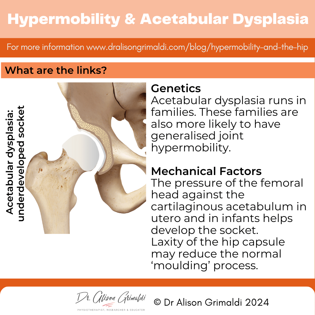 hypermobility-and-acetabular-dysplasia hypermobility-and-acetabular-dysplasia