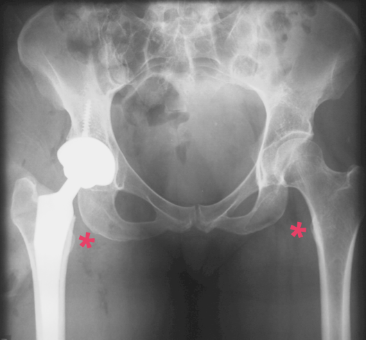 Impingement of the QF muscle Impingement of the QF muscle