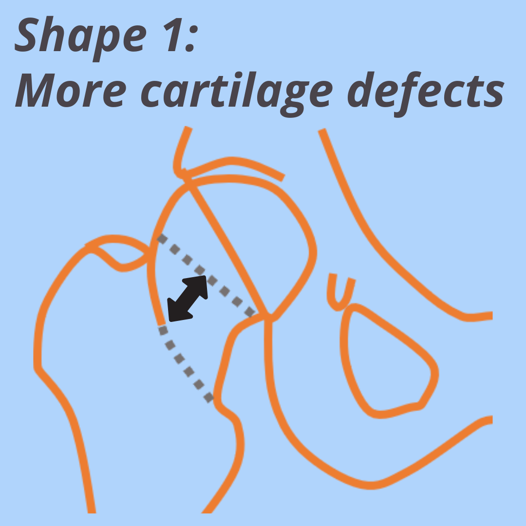 Shape 1: More cartilage defects Shape 1: More cartilage defects