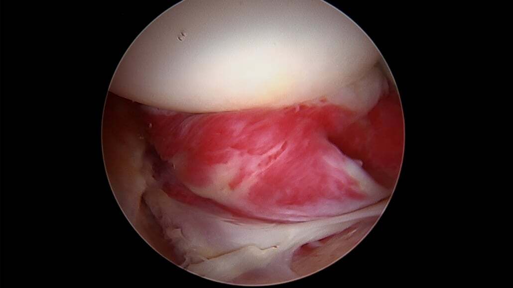 Synovitis of the Ligamentum Teres & Pulvinar Fat Pad