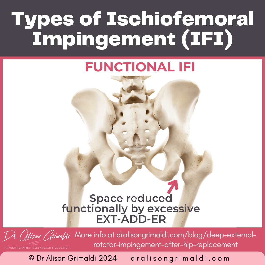 types-of-ischiofemoral-impingement