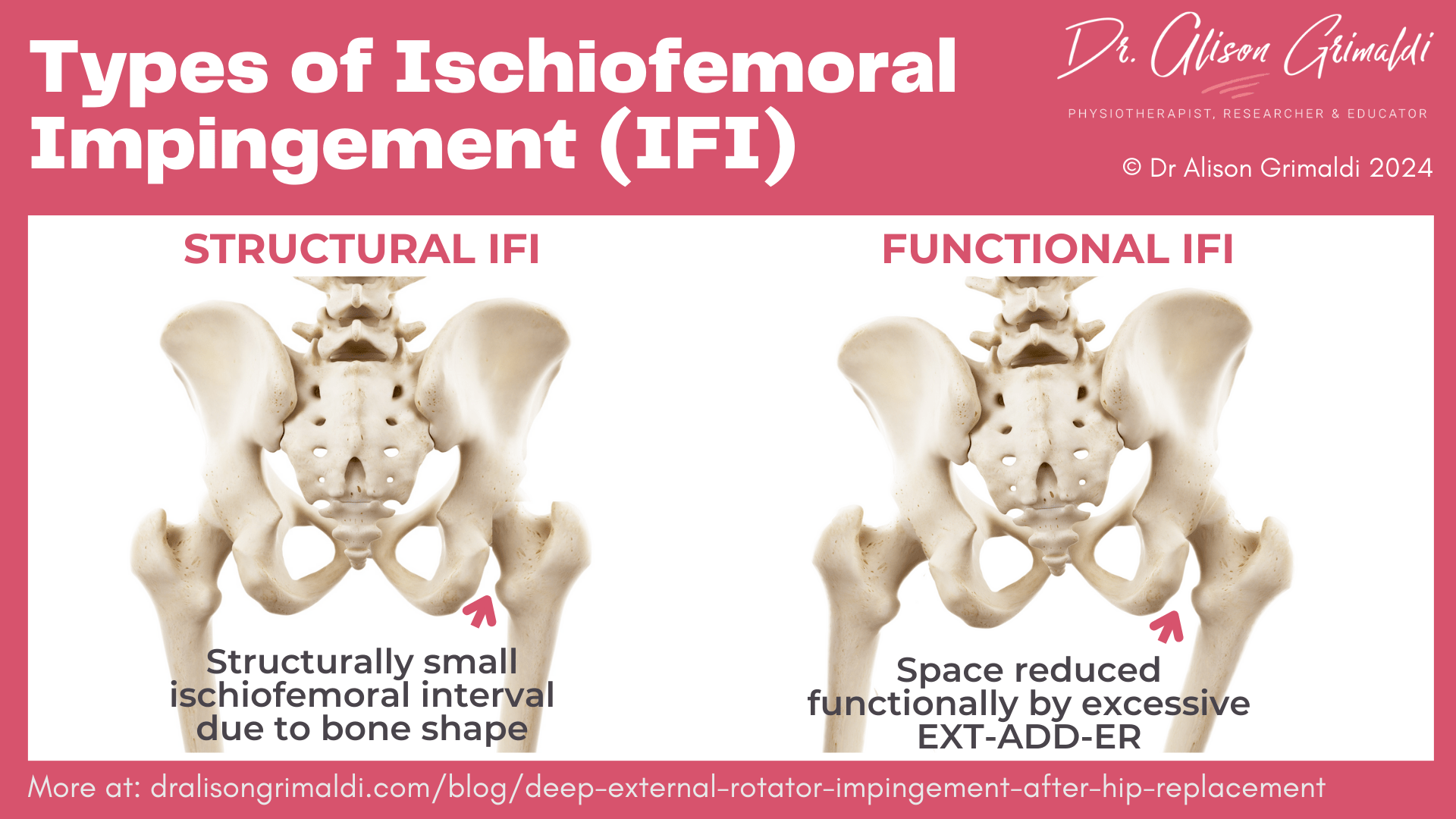 types-of-ischiofemoral-impingement