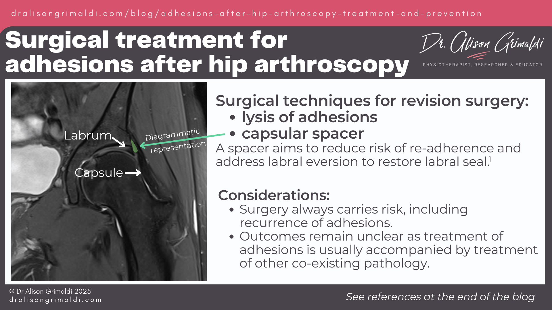surgical-treatment-for-adhesions-after-hip-arthroscopy surgical-treatment-for-adhesions-after-hip-arthroscopy
